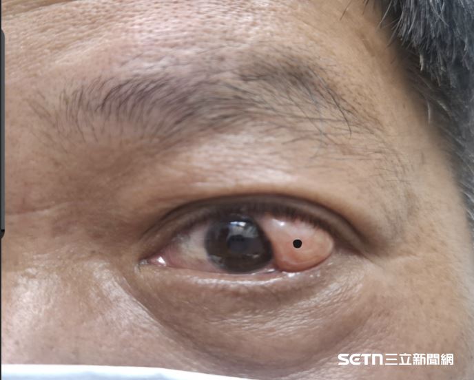 肉身二郎神？6旬男冒「第3隻眼」畫面曝光，醫生替其動手術後已經恢復原貌。（圖／洪啟庭提供）