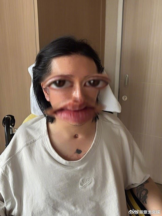 去年李啟言(阿Mo)曾罕見公開近照,喉嚨清楚可見手術切口疤痕,畫面令人心疼。(圖/翻攝自IG @momo.lky)