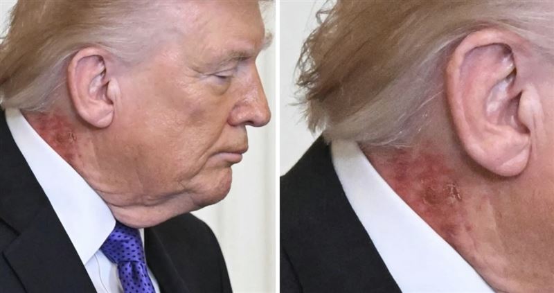 川普被拍到右側脖子出現紅疹、脫屑狀況。（翻攝X@buffys）