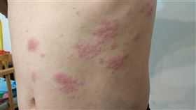 壓力,紅疹,抽痛,皮膚病,衛福部彰化醫院,莊佳慧,帶狀皰疹,皮蛇