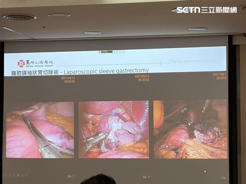 王柏鈞醫師說明袖狀胃切除術。(圖/記者簡浩正攝影)