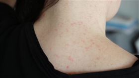 皮膚癢總是好不了？慢性搔癢的３大關鍵　醫：正確照護最重要。（圖／醫健新聞網提供） 