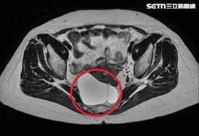 婦出車禍反保命　意外揪出直腸長腫瘤（圖／翻攝畫面）