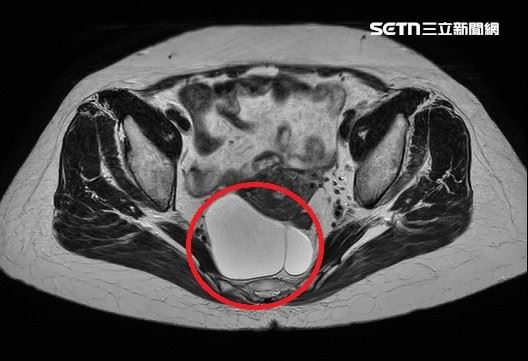 婦出車禍反保命　意外揪出直腸長腫瘤