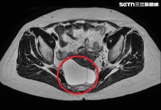 婦出車禍反保命　意外揪出直腸長腫瘤