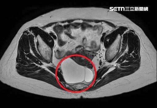 婦出車禍反保命　意外揪出直腸長腫瘤