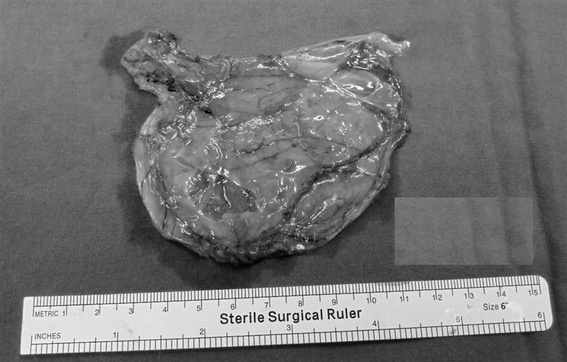 張姓女子因為出車禍送醫,檢查時意外揪出腹內藏著10公分腫瘤。(圖/亞大附醫提供)