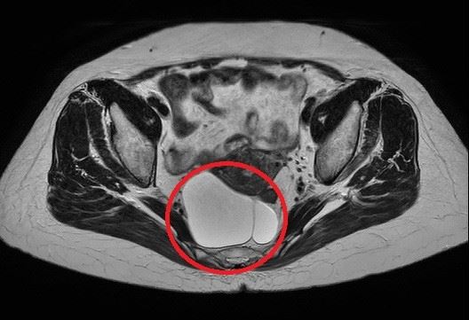 張姓女子因為出車禍送醫,檢查時意外揪出腹內藏著10公分腫瘤。(圖/亞大附醫提供)