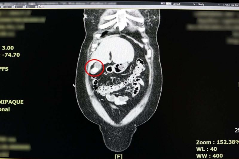 膽結石引發的疼痛為「飽痛」，痛點常位於右上腹、右背。圖：聯新國際醫院提供。（圖／桃園電子報提供）