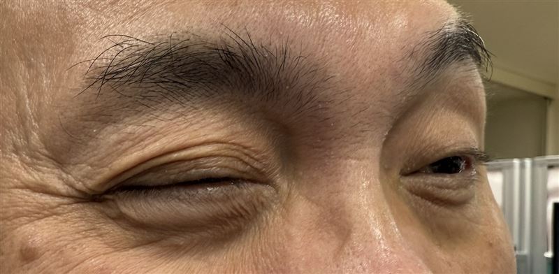 60歲男子右眼連跳3週，懷疑是不祥之兆，甚至擔心是中風前兆，經醫師診斷為「自律神經失調」所致的眼皮抽動。（圖／衛福部彰化醫院提供）