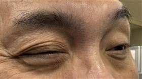 60歲男子右眼連跳3週就醫，確認眼壓正常，無器質性病變，診斷與自律神經失衡有關，多休息即可改善。（圖／衛福部彰化醫院提供）