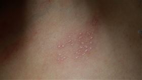 忽略這事…爸染皮蛇害不到1歲女兒長水痘　妻後來也中鏢！（圖／台中慈院提供）