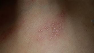 「驚蟄」常見1疾病恐高燒！醫揭必吃4食材