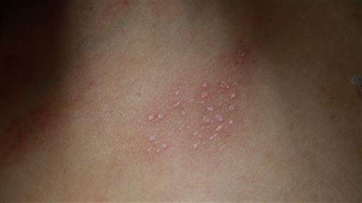 「驚蟄」常見1疾病恐高燒！醫揭必吃4食材