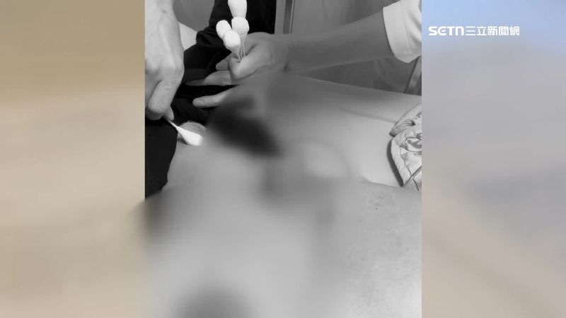 去年一名曾罹患乳癌的A小姐，做豐胸手術後，雙胸感染被迫切除義乳