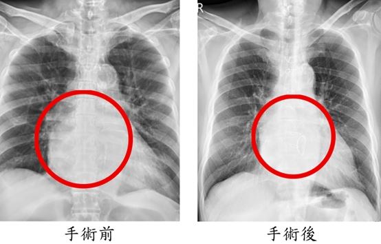 醫師依序進行冠狀動脈繞道手術、僧帽瓣修補、心室重建與冷凍去顫治療，手術歷時8小時，兩天後順利移出加護病房。(圖／台中市立老人復健綜合醫院提供)
