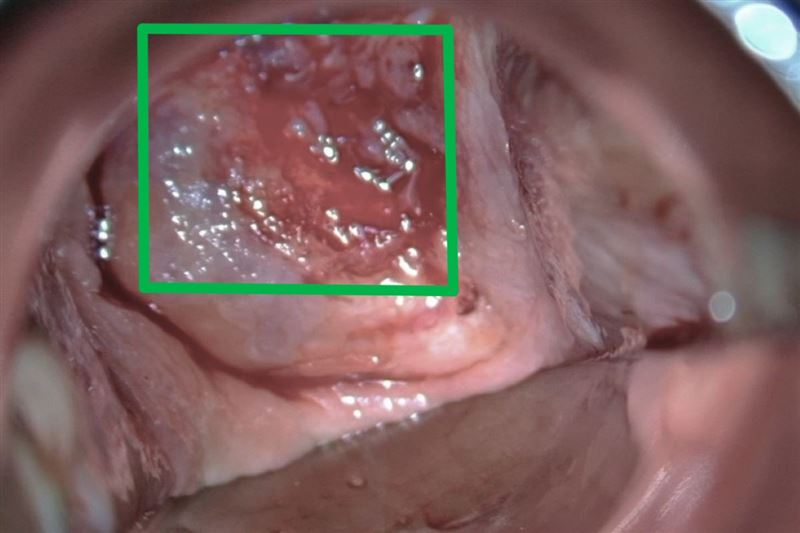 醫師表示，若經檢查發現子宮頸出現如綠框處的不正常出血及糜爛症狀，會進一步切片確認是否為癌變。（圖／台北慈濟醫院提供）
