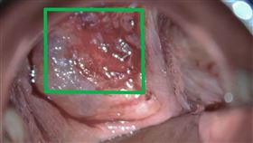 醫師表示，若經檢查發現子宮頸出現如綠框處的不正常出血及糜爛症狀，會進一步切片確認是否為癌變。（圖／台北慈濟醫院提供）