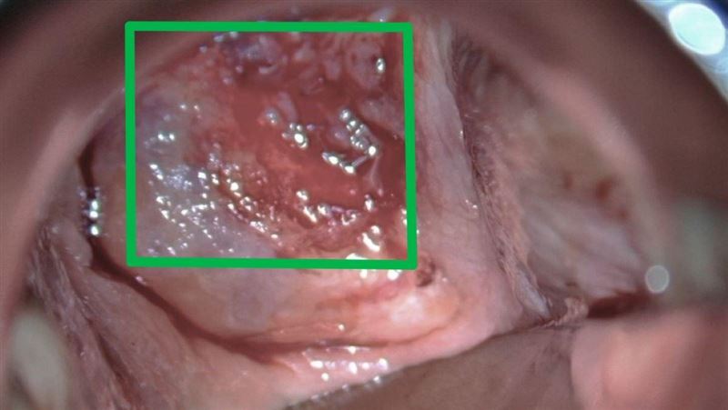 她備孕竟「子宮頸異常」醫嘆：已癌前病變