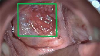 醫師表示，若經檢查發現子宮頸出現如綠框處的不正常出血及糜爛症狀，會進一步切片確認是否為癌變。（圖／台北慈濟醫院提供）