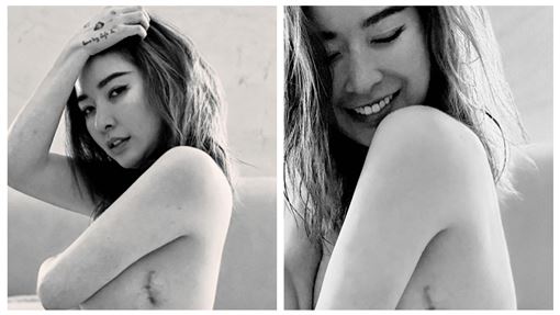 許維恩罹癌切乳續命 蟹足腫留疤:珍貴勳章