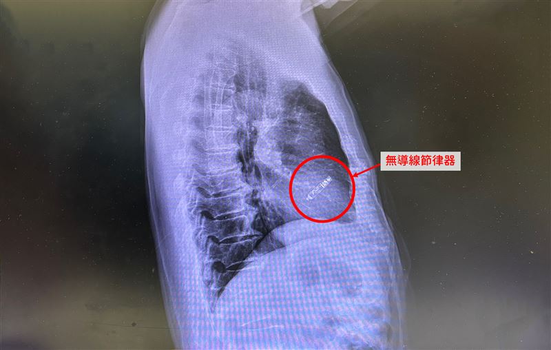 75歲婦女長期頭暈昏倒，檢查發現心跳過慢、頻繁暫停，診斷為病竇症候群。經治療後，症狀明顯改善，降低暈厥與併發症風險。（圖／中國醫藥大學新竹附設醫院提供）
