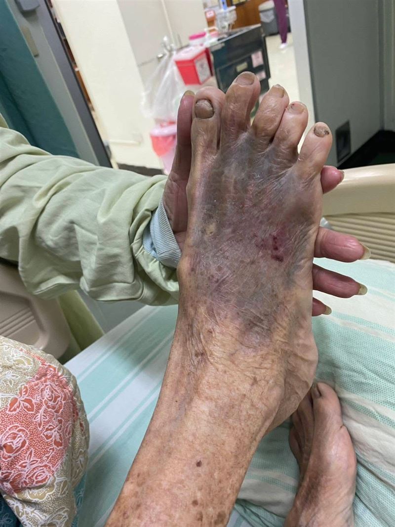 受害的阿嬤腦出血及臉部、四肢瘀青挫傷,住進加護病房。(圖/翻攝自臉書)