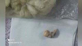 水煎包驚見假牙！牙醫曝：是人類脫落的