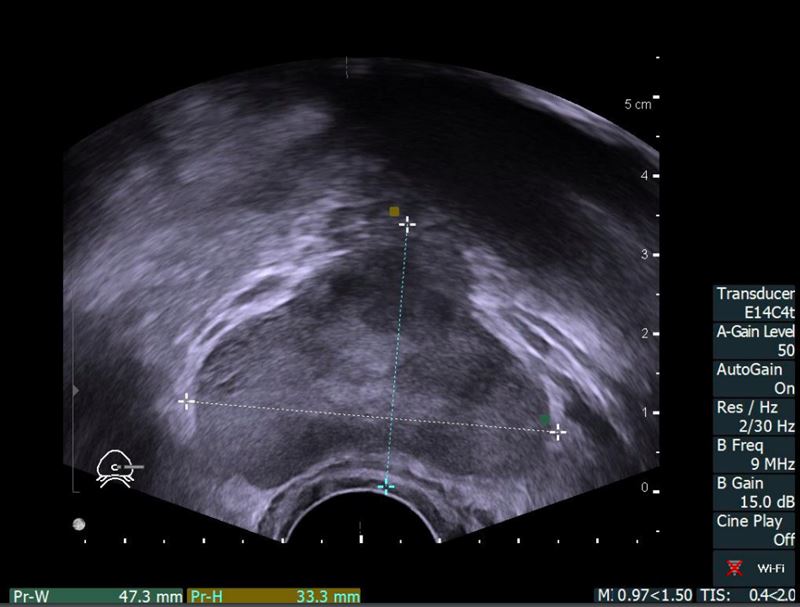 陳先生一年多前健康檢查時發現PSA數值過高而求診，沒想到後續竟罹攝護腺癌。（圖／書田診所提供）