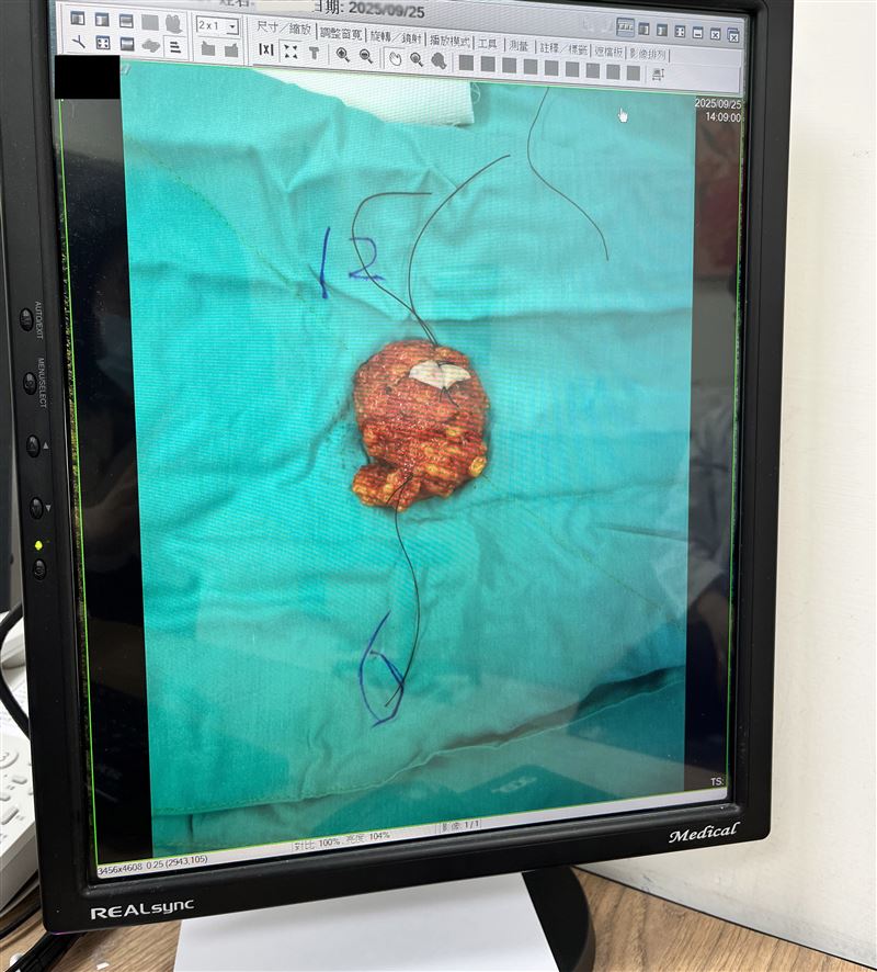 廖志斌醫師診斷此病人為管腔B1型乳癌第二期,且腫瘤已達2.9公分大。(圖/光田醫院提供)