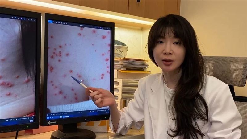 以為濕疹狂擦類固醇藥膏　26歲女變紅豆胸
