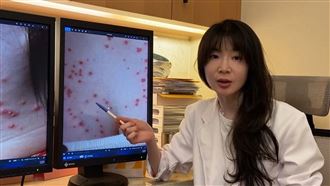 以為濕疹狂擦類固醇藥膏　26歲女變紅豆胸