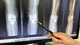 61歲清潔婦，雙膝退化，忍痛不哩，軟骨突脫落，趴地，無法站(圖 ／大甲李綜合醫院提供)