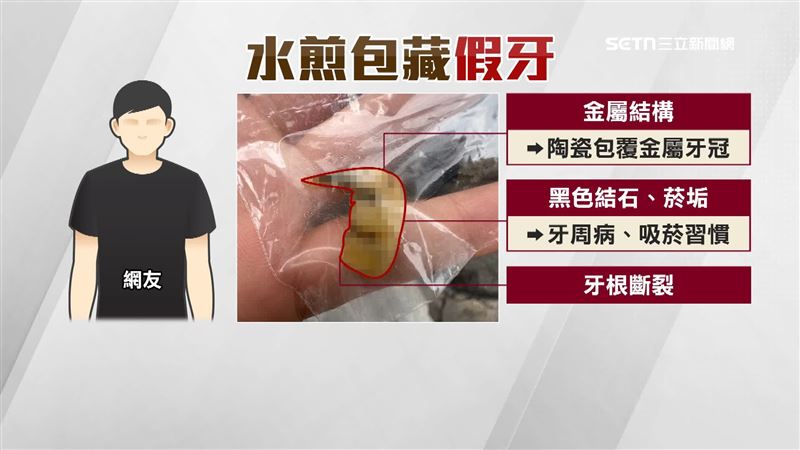 牙醫證實確定為人類的牙齒,並有牙周病等症狀