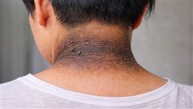 黑色棘皮症。（示意圖／AI製圖）