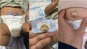 嬰兒肚臍凸出　嬤搞偏方「貼硬幣」醫傻眼