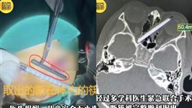 筷子不慎插入男童眼睛。（圖／取自微博）