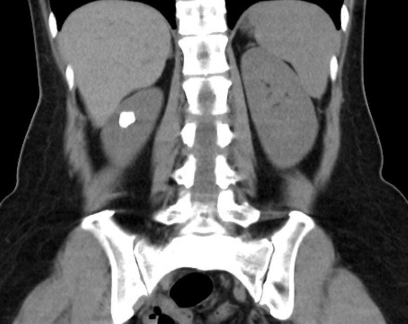 電腦斷層影像中,可見田女士左側腎臟的結石集合體嵌在憩室內。(圖/台北慈濟醫院提供)