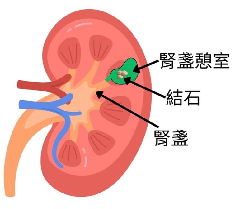 腎盞憩室構造與結石示意圖。(圖/台北慈濟醫院提供)