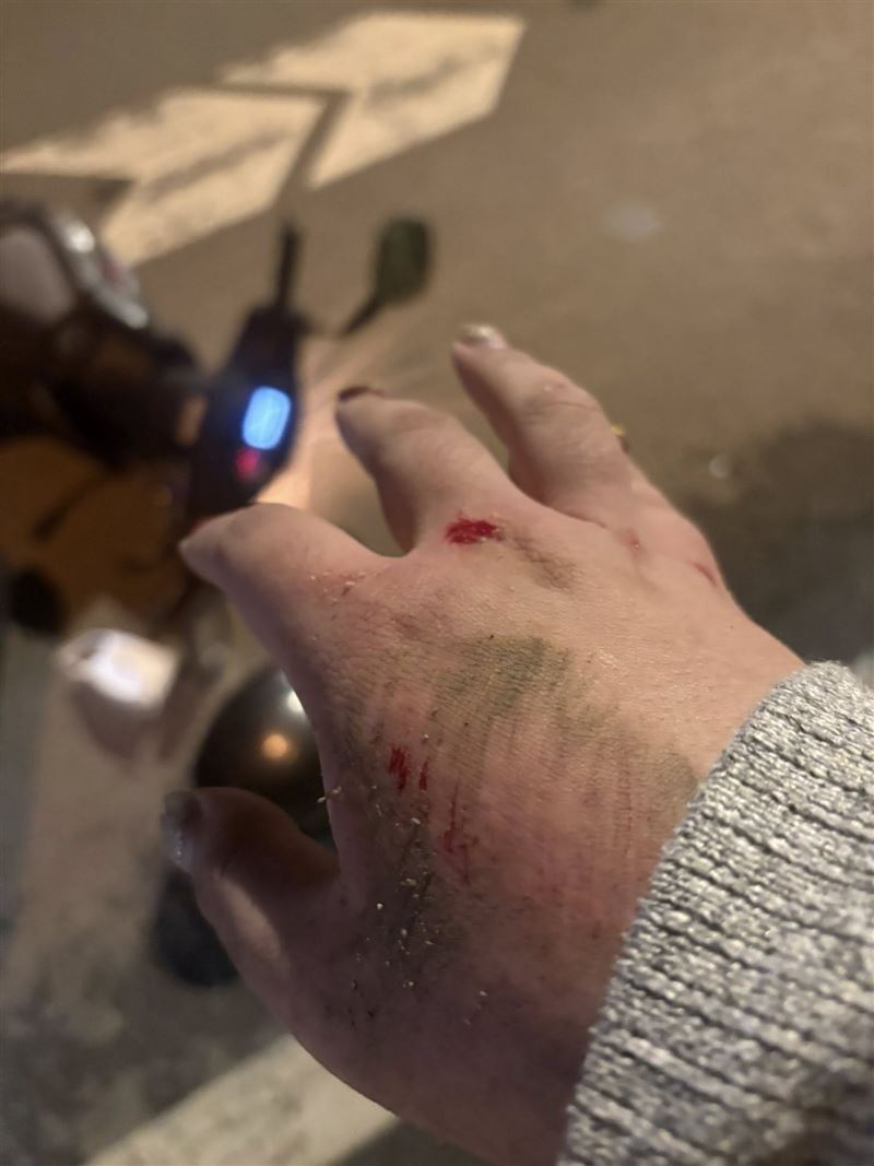 珮珮兒在臉書上Po出車禍傷勢。（圖／翻攝自臉書）