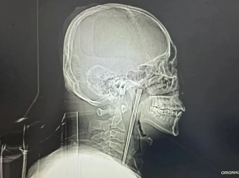 男誤吞12公分筷子「卡喉嚨8年」才取出。(圖/翻攝微博)