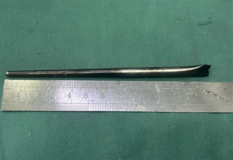 男誤吞12公分筷子「卡喉嚨8年」才取出。(圖/翻攝微博)