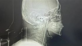 男誤吞12公分筷子「卡喉嚨8年」才取出。（圖／翻攝微博）