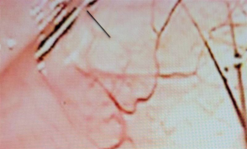 右眼在裂隙燈下靠近顳側有明顯的兩根睫毛，呈現交叉 十字(紅色圓圈)，深度在結膜下方。另外在右上方還有另一根睫毛(藍色箭頭)，推測其約有3/4長度已經落到眼球後方，可能會完全慢慢滑落至眼球後面，將造成失明甚至喪命。（圖／翻攝畫面）