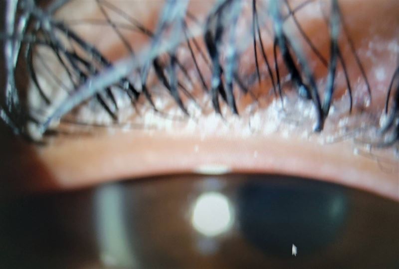 個案種植的睫毛，使雙眼炯炯有神，但可能在廟會活動中跳舞，環境壅擠悶熱，容易受油脂與汗水分解，因此容易掉睫毛。（圖／翻攝畫面）