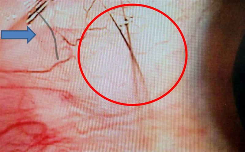 右眼在裂隙燈下靠近顳側有明顯的兩根睫毛，呈現交叉十字（紅色圓圈），深度在結膜下方，另外在右上方還有另一根睫毛（藍色箭頭），推測其約有3/4長度已經落到眼球後方，可能會完全慢慢滑落至眼球後面，將造成失明甚至喪命。（圖／翻攝畫面）