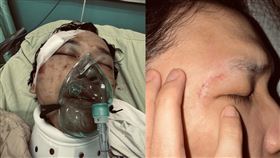 豆腐媽媽臨演出院一個月仍在療傷，眼睛受到壓迫無法睜開。（圖／翻攝自threads）