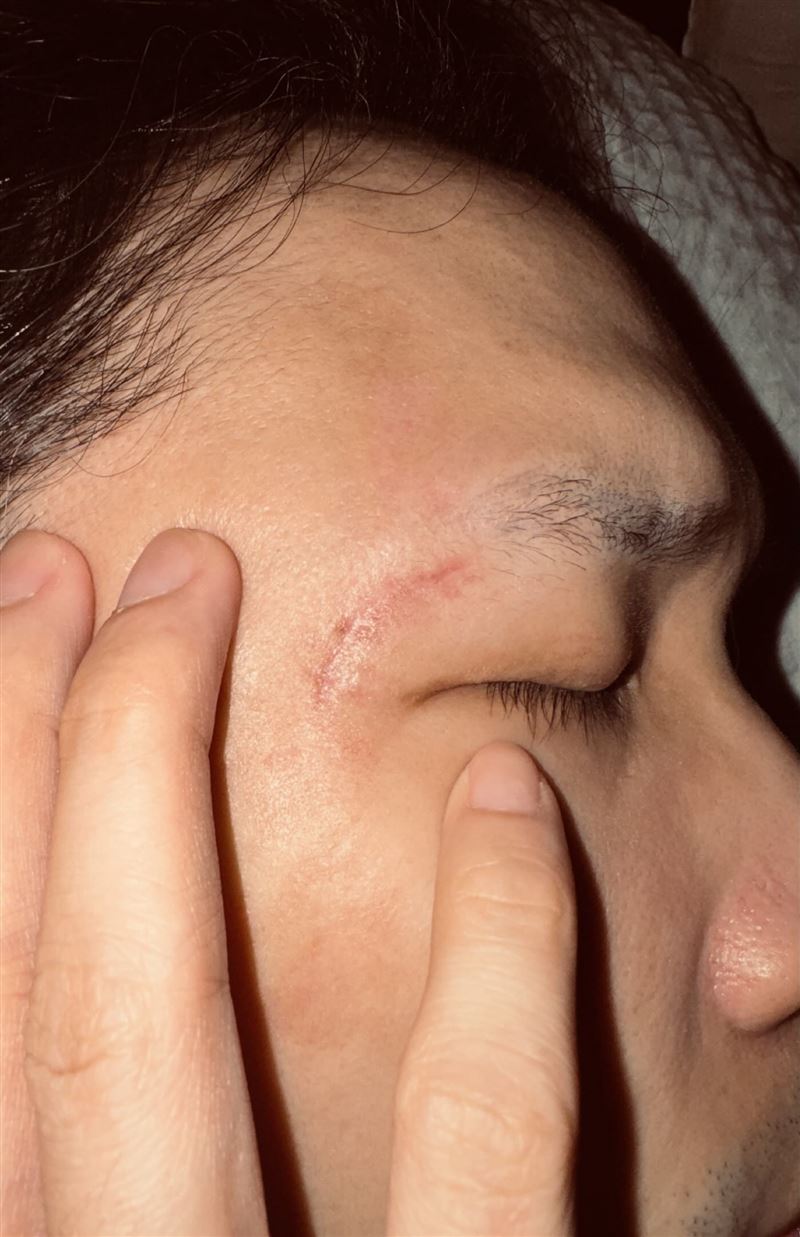 豆腐媽媽臨演出院一個月仍在療傷，眼睛受到壓迫無法睜開。（圖／翻攝自threads）