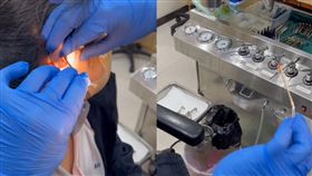 耳朵出現蟑螂。（圖／耳鼻喉科醫師莊宇龍授權提供）