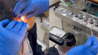 國中妹耳朵爆痛！醫夾出活蟑螂：牠猛踢腿